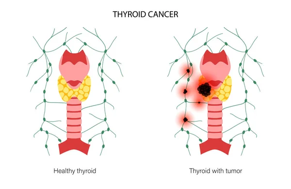 Estadios del cáncer de tiroides — Vector de stock