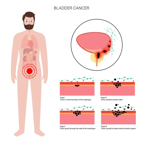 膀胱がんの病期 — ストックベクタ