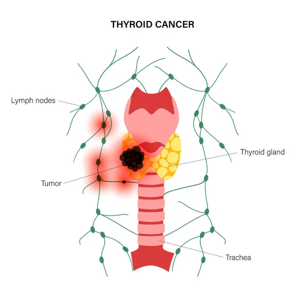 Estadios del cáncer de tiroides — Vector de stock