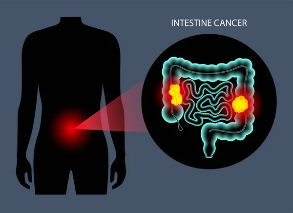 Cáncer intestinal 3D — Vector de stock