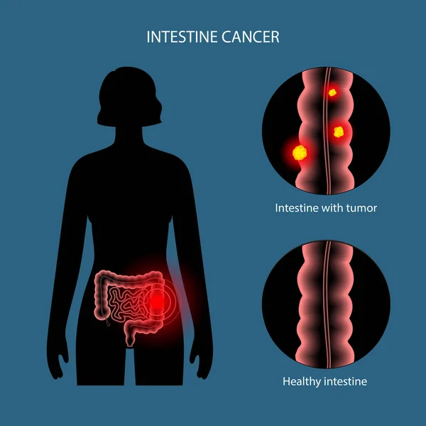 肠胃3D癌 — 图库矢量图片