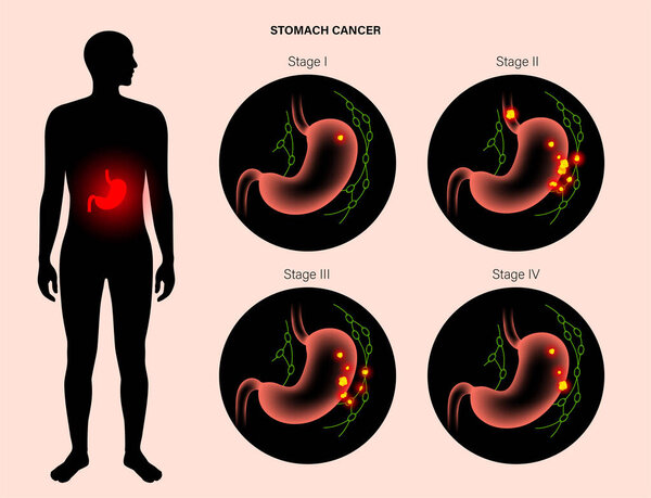 Stomach cancer anatomy