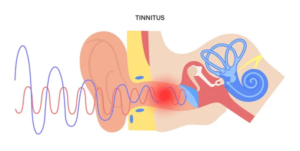 Tinnitus sjukdom koncept — Stock vektor