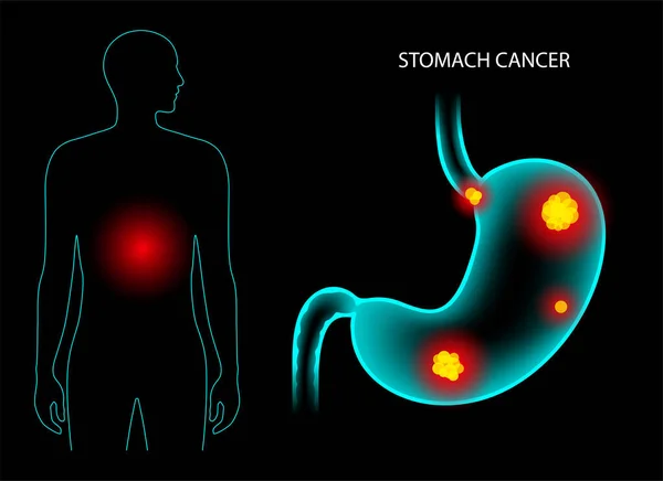 Anatomía del cáncer de estómago — Vector de stock