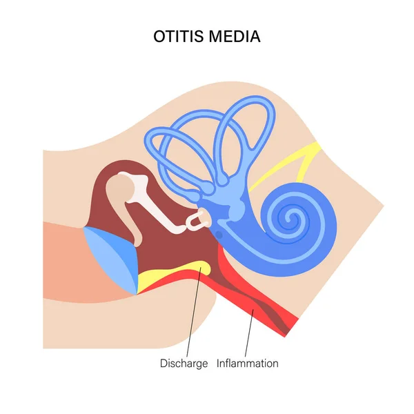 Otitis media enfermedad — Vector de stock