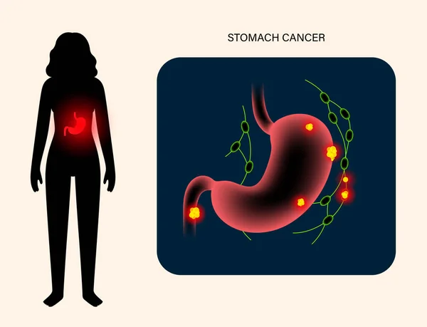 Anatomia del cancro allo stomaco — Vettoriale Stock