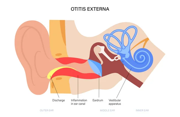 Otitis del oído de nadadores — Vector de stock