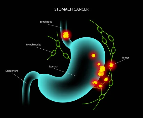 Anatomía del cáncer de estómago — Vector de stock