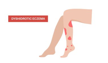 Dyshidrotic eczema. Itchy fluid filled blisters on feet and fingers. Skin inflammation, sweat gland dysfunction and allergic reaction. Chronic dermatitis with, cracking, redness and irritation vector