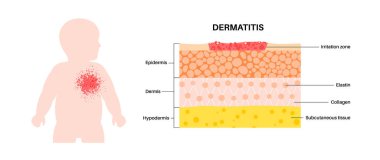 Dermatitis on the child skin layers diagram. Eczema, inflammation and allergic rash with redness, itching and dry patch on the infant body. Atopic reaction, inflamed epidermis, irritation and swelling