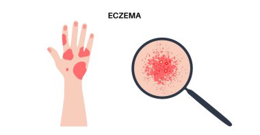 Atopic dermatitis or eczema. Itchy fluid filled blisters on hands and fingers. Skin inflammation, sweat gland dysfunction, allergic reaction. Chronic redness, cracking, irritation vector illustration
