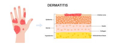 Dermatitis or eczema and skin layers diagram. Itchy fluid filled blisters on hand and fingers. Skin inflammation, sweat gland dysfunction, allergic reaction. Chronic redness, irritation medical vector
