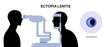 Ektopi lensi, yerinden çıkmış ya da göz merceği altı. Kesik lambayla oftalmoloji randevusu. Bağlayıcı doku anatomisi, görme bozukluğu ve genetik hastalık. Sağlık ve klinik araştırma vektörü