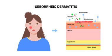 Seborrheic dermatitis ve deri katmanları diyagramı. Yüzünde ve ağzında pullu yamalar ve kızarıklık, kronik iltihap. Malassezia mantarı ve yağlı bez aktivitesi. Kaşıntı, pul pul ve tahriş vektörü