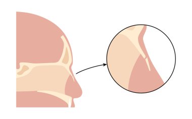 Burun kırığı posteri. Travma ya da darbe burun kemiğini kırar. Ağrı, şişlik, çürük, kanama ve nefes darlığı. Kemik kayması, kıkırdak hasarı, tomografi veya MRI vektör çizimi.