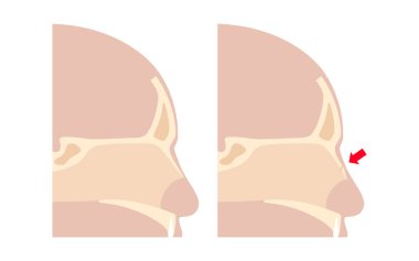 Burun kırığı posteri. Travma ya da darbe burun kemiğini kırar. Ağrı, şişlik, çürük, kanama ve nefes darlığı. Kemik kayması, kıkırdak hasarı, tomografi veya MRI vektör çizimi.