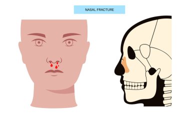 Burun kırığı posteri. Travma ya da darbe burun kemiğini kırar. Ağrı, şişlik, çürük, kanama ve nefes darlığı. Kemik kayması, kıkırdak hasarı, tomografi veya MRI vektör çizimi.