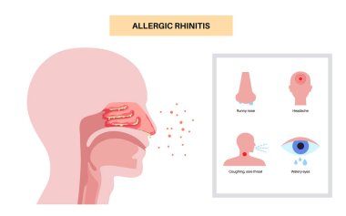Alerjik Rhinitis tıbbi afişi. Polen, toz, küf ya da evcil kıl burun iltihabını tetikler. Hapşırma, mukus boşalması ve kaşıntı. Bağışıklık sistemi histamine tepkisi konsepti. Tıkanıklık, sinüs tahriş vektörü