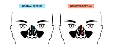 Burun dekoltesi ve burun tıkanıklığı posteri. Solunum problemleri, tıkanıklık ve horlama. Sinüzit ve hava akışı tıkanıklığı. Kıkırdak ve kemik sapmasının tıbbi vektör çizimi
