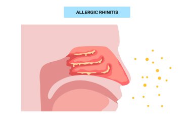 Alerjik Rhinitis tıbbi afişi. Polen, toz, küf ya da evcil kıl burun iltihabını tetikler. Hapşırma, mukus boşalması ve kaşıntı. Bağışıklık sistemi histamine tepkisi konsepti. Tıkanıklık, sinüs tahriş vektörü