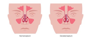 Burun dekoltesi ve burun tıkanıklığı posteri. Solunum problemleri, tıkanıklık ve horlama. Sinüzit ve hava akışı tıkanıklığı. Kıkırdak ve kemik sapmasının tıbbi vektör çizimi