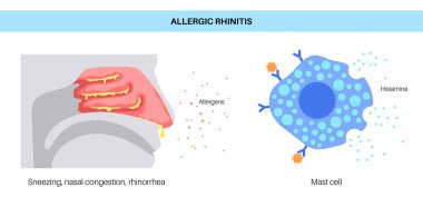 Alerjik Rhinitis tıbbi afişi. Polen, toz, küf ya da evcil kıl burun iltihabını tetikler. Hapşırma, mukus boşalması ve kaşıntı. Bağışıklık sistemi histamine tepkisi konsepti. Tıkanıklık, sinüs tahriş vektörü