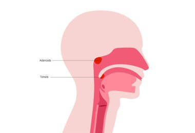 Adenotonsillar hastalık posteri. Kronik iltihap ve adenoit ve bademciklerde büyüme. Solunum yolu tıkanması, horlama ve nefes alma zorluğu. Lenf dokusu, boğaz anatomisi düz vektör.