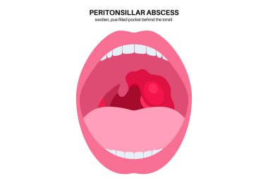 Peritonsiller apse posteri. Bademcik yakınlarında bakteriyel enfeksiyon. Şişlik, iltihap birikmesi, boğaz ağrısı, ateş ve acı verici yutma. İltihaplı doku, uvula sapması ENT düz vektör çizimi