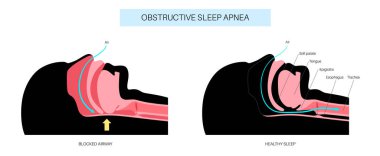 Engelleyici uyku apnesi. Uyurken solunum yolu çöker. Nefes almakta, horlamakta ve oksijen damlalarında duraksamalar. Yorgunluk ve sağlık riskleri. Solunum yolu tıkanıklığı, dil pozisyonu ve CPAP tedavi vektörü
