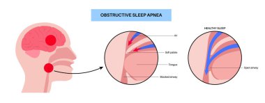 Engelleyici uyku apnesi. Uyurken solunum yolu çöker. Nefes almakta, horlamakta ve oksijen damlalarında duraksamalar. Yorgunluk ve sağlık riskleri. Solunum yolu tıkanıklığı, dil pozisyonu ve CPAP tedavi vektörü