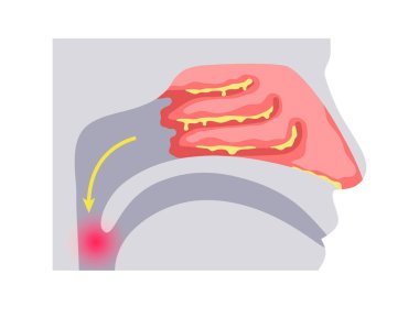 Postnazal damlalı tıbbi poster. Sinüslerden boğaza fazla sümük boşalıyor. Öksürük, tahriş ve tıkanıklık. Mukus akışı, burun drenajı, iltihap ve solunum yolu düz vektör rahatsızlığı.