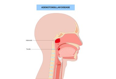 Adenotonsillar hastalık posteri. Kronik iltihap ve adenoit ve bademciklerde büyüme. Solunum yolu tıkanması, horlama ve nefes alma zorluğu. Lenf dokusu, boğaz anatomisi düz vektör.
