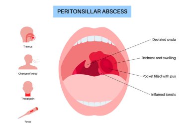 Peritonsiller apse posteri. Bademcik yakınlarında bakteriyel enfeksiyon. Şişlik, iltihap birikmesi, boğaz ağrısı, ateş ve acı verici yutma. İltihaplı doku, uvula sapması ENT düz vektör çizimi