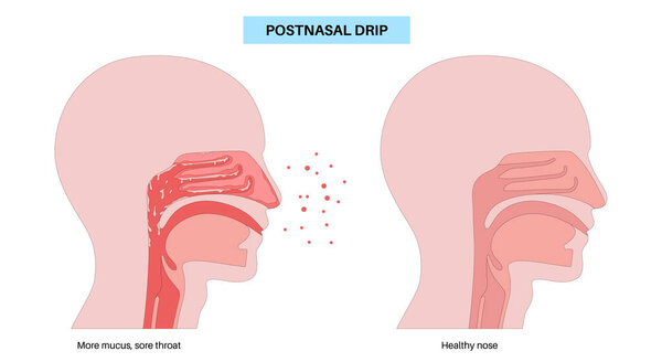 Постназальный плакат с капельницей. Избыток слизи стекает из пазух в горло. Кашель, раздражение и заторы. Поток слизи, дренаж носа, воспаление и дискомфорт дыхательных путей плоский вектор