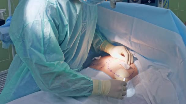 Chirurgie corporală operație medicală clouseup — Videoclip de stoc