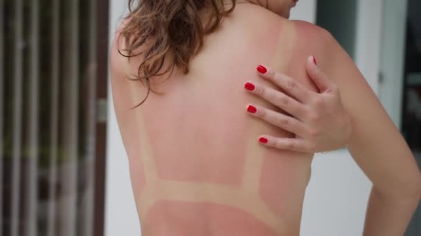 A girl with a red manicure touches her sun-burned, reddened back on the street on a sunny day. A woman touches her back, on which there is a trace of sunburn in the form of a swimsuit. Slow motion. — Stock Video