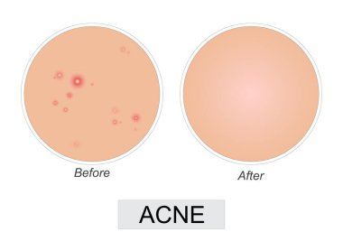 Tedavi öncesi ve sonrası akne derisi durumunu gösteren vektör illüstrasyonu. Güzellik, tıbbi ve kozmetik reklamları için cilt bakımı ve cilt bakımı kavramı, temiz düz tasarım tarzında sunulmaktadır..