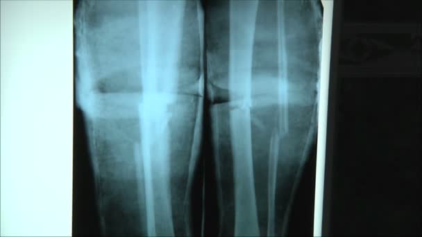 Raios-X de pernas quebradas — Vídeo de Stock