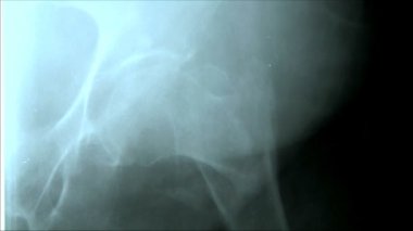 X-ışını kırık bacak