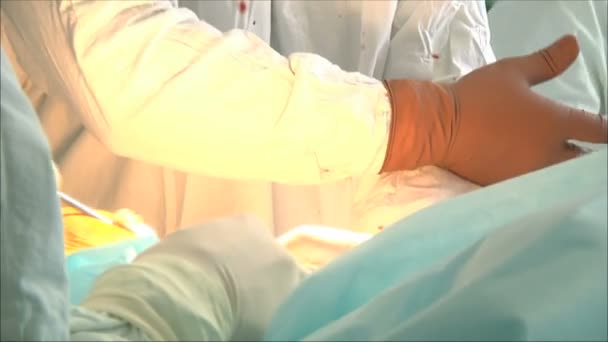 Хірургічна операція в лікарні — стокове відео