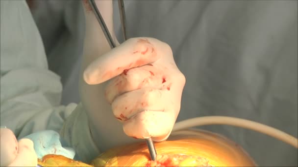 Operacji chirurgicznej w szpitalu — Wideo stockowe