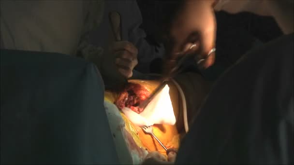 Operación quirúrgica en el hospital — Vídeo de stock