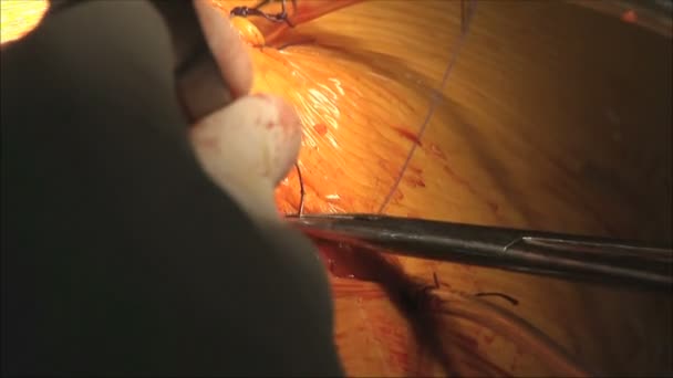 Operação cirúrgica no hospital — Vídeo de Stock