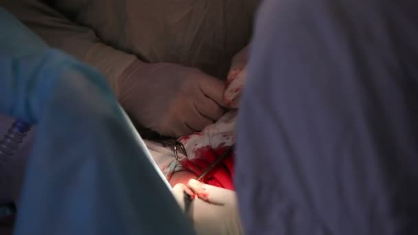 Cirugía en el abdomen en una operación estéril — Vídeo de stock