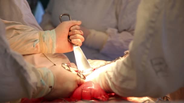 Χειρουργική επέμβαση στην κοιλιακή χώρα σε ένα αποστειρωμένο λειτουργικές — Αρχείο Βίντεο