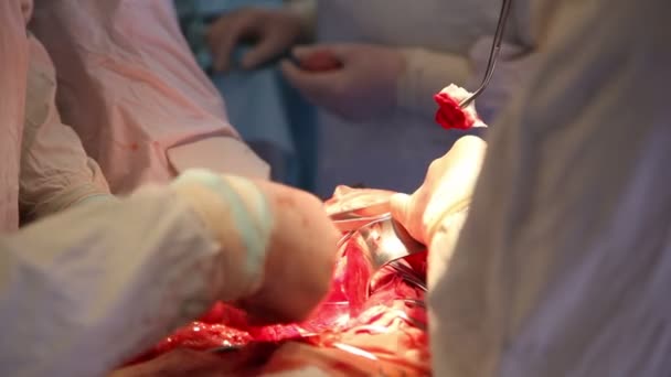 Cirurgia no abdômen em uma operação estéril — Vídeo de Stock