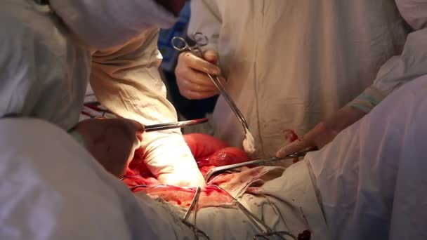 Χειρουργική επέμβαση στην κοιλιακή χώρα σε ένα αποστειρωμένο λειτουργικές — Αρχείο Βίντεο
