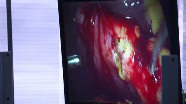 Laparoscopische chirurgie op de monitor — Stockvideo