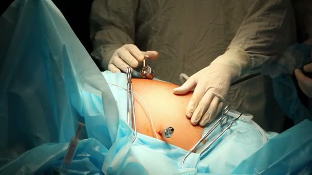 Laparoskopische Chirurgie des Bauches — Stockvideo