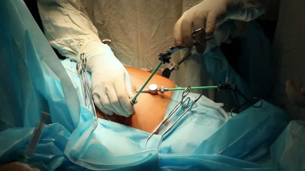 Лапароскопическая хирургия брюшной полости — стоковое видео